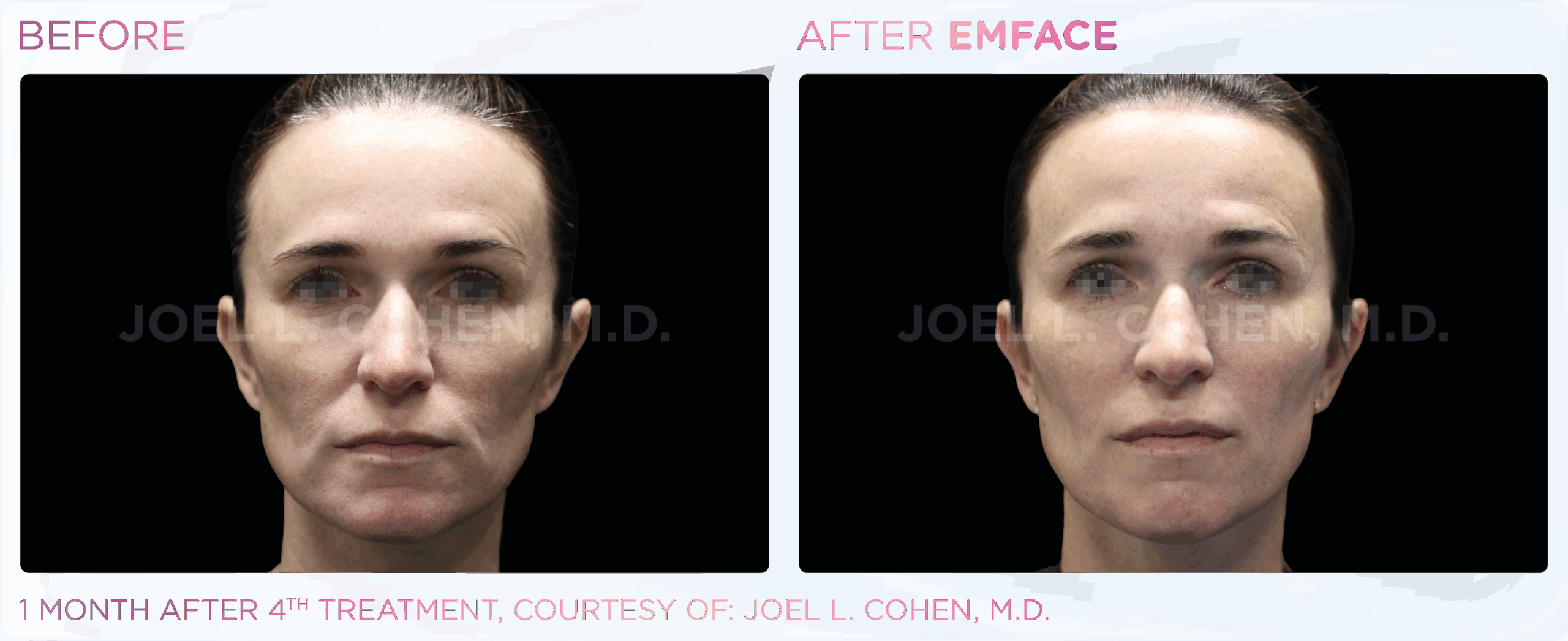 1 month after the 4th treatment
