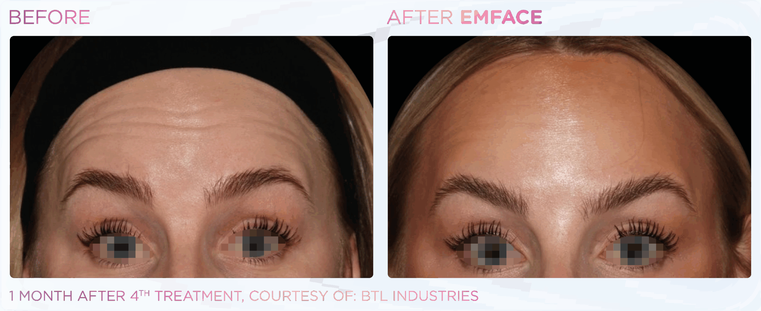 1 month after 4th treatment