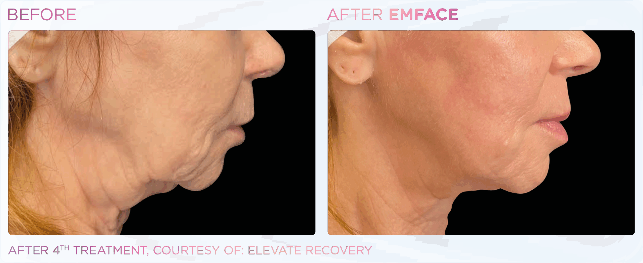 After 4th treatment